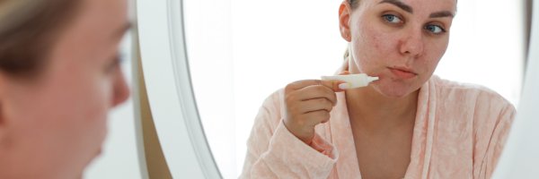 Yetişkin Aknesi Neden Olur?