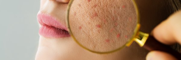 Akne ve Leke Tedavileri