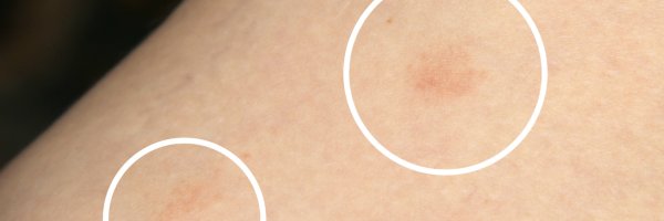Gül Hastalığı – Çam Çiçeği Hastalığı (Pityriasis Rosea)